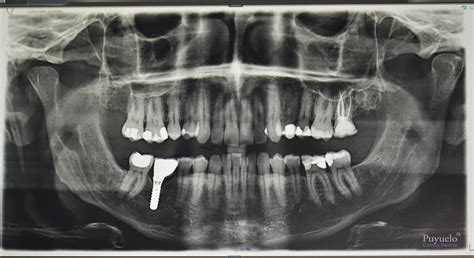 Ejemplo de una ortopantomografía con y sin artefactos de protección radiológica.