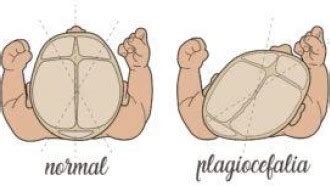 Infografía comparativa: diferencias visuales entre una cabeza con plagiocefalia postural y una con craneosinostosis.