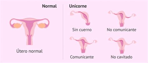 Representación esquemática de un útero unicorne con cuerno rudimentario