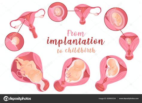 Esquema anatómico que ilustra la diferencia entre un embarazo intrauterino normal y la implantación en el cuerno uterino (región cornual/intersticial).