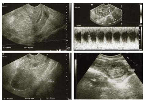 Imagen de ecografía transvaginal mostrando la placenta cubriendo el cuello uterino.