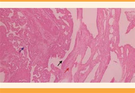 Corte histológico que muestra la invasión del trofoblasto al miometrio, confirmando el acretismo placentario.