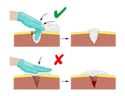 Esquema ilustrando la técnica de taponamiento pélvico para el control de hemorragia posparto.