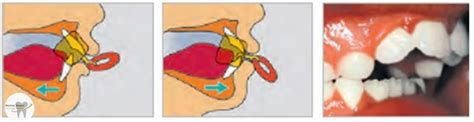 Infografía sobre los riesgos dentales del uso prolongado del chupete