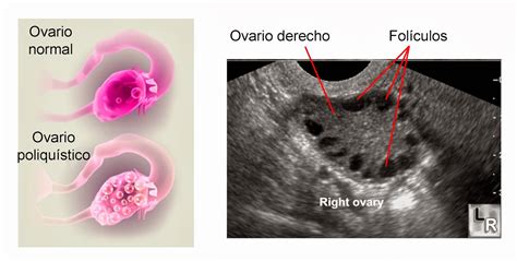 Ecografía transvaginal mostrando ovarios con múltiples folículos