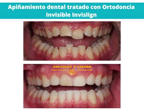 Ilustración que muestra un ejemplo de apiñamiento dental y dientes de tiburón durante la dentición mixta.
