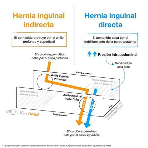 Esquema anatómico mostrando la diferencia entre una hernia inguinal directa y una indirecta en la zona abdominal.