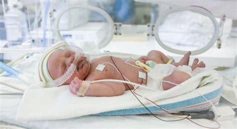 Fotografía de un bebé prematuro en incubadora