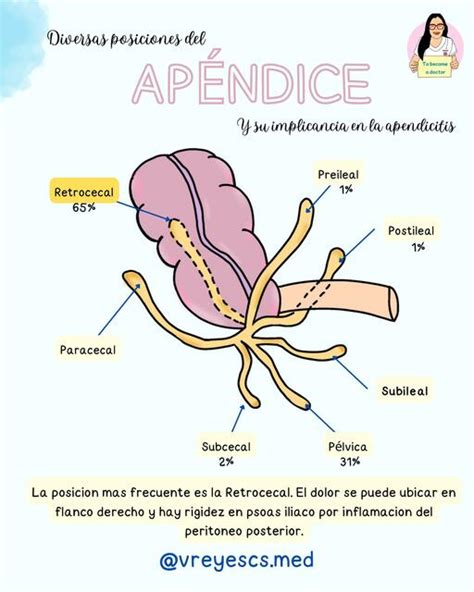 Anatomía del apéndice cecal y su ubicación en el abdomen inferior derecho