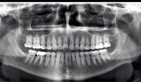 Radiografía dental de la boca de un bebé para evaluar dientes natales