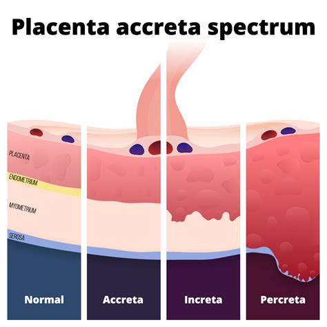 Diagrama mostrando la diferencia entre placenta accreta, increta y percreta