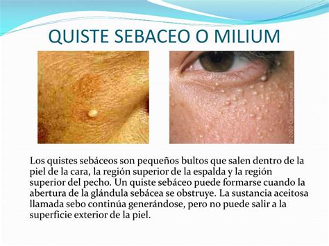Esquema de un quiste de milium bajo la piel del bebé con queratina atrapada