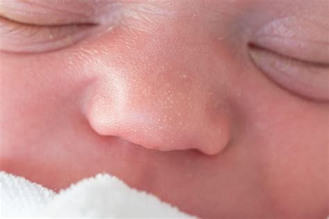 Fotografía de un bebé con quistes de milium en la nariz y las mejillas