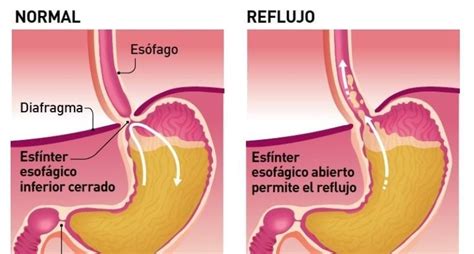 Esquema anatómico mostrando el esfínter esofágico inferior y el proceso de reflujo en un bebé