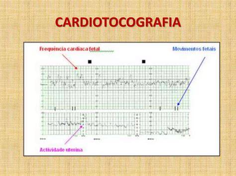 Esquema de un cardiotocograma: bandas abdominales para el registro del latido fetal y las contracciones.