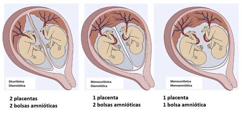 Esquema de un embarazo gemelar mostrando un feto con anomalías y otro sano