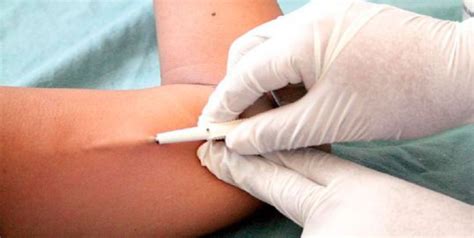 Fotografía de un implante anticonceptivo subdérmico y su lugar de aplicación en el brazo