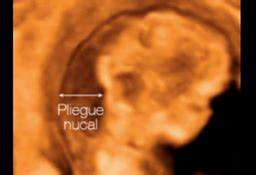 Imagen de una ecografía del primer trimestre mostrando el pliegue nucal