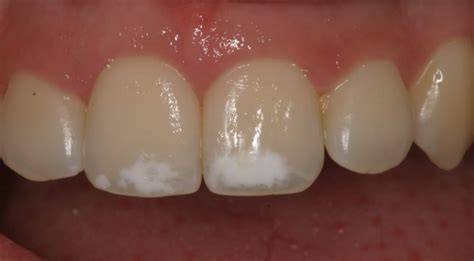 Fotografía de dientes con manchas blancas y amarillentas por descalcificación