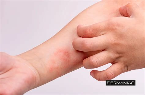 Foto de piel con lesiones eccematosas y rascado debido a dermatitis atópica