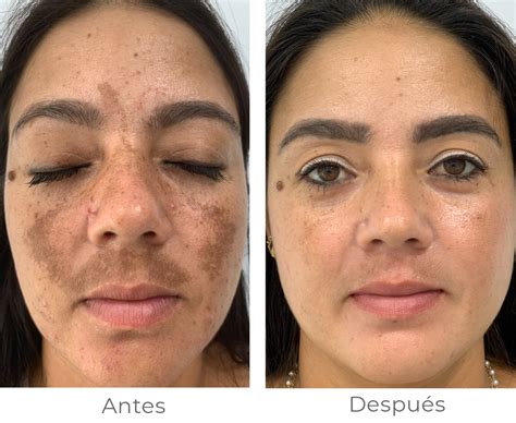 Foto de una mujer con melasma facial, destacando las manchas