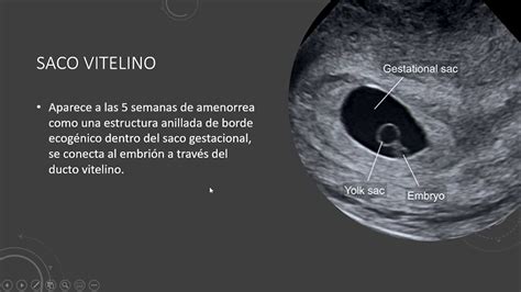 Ecografía de saco gestacional y saco vitelino temprano