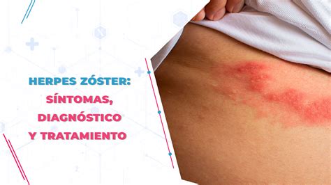 Imagen de una erupción típica de herpes zóster en el cuerpo
