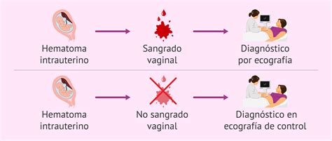 Imagen de una ecografía mostrando un hematoma intrauterino