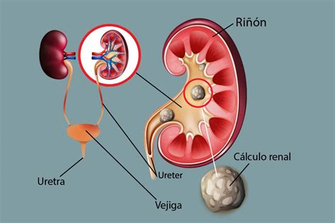 Diagrama que muestra cálculos renales obstruyendo las vías urinarias