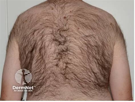 Hipertricosis, crecimiento de pelo suave y delgado