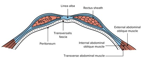 Esquema de la anatomía abdominal femenina con la línea alba y los músculos rectos abdominales