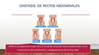 Ilustración que muestra la separación de los rectos abdominales durante el embarazo debido al crecimiento uterino