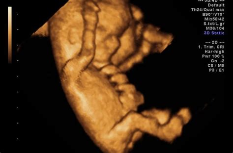 Ecografía de un bebé en posición cefálica a las 33 semanas de gestación