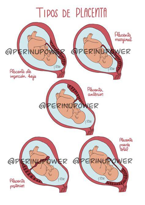 Ilustración de las diferentes posiciones de la placenta en el útero: anterior, posterior, fúndica y baja.