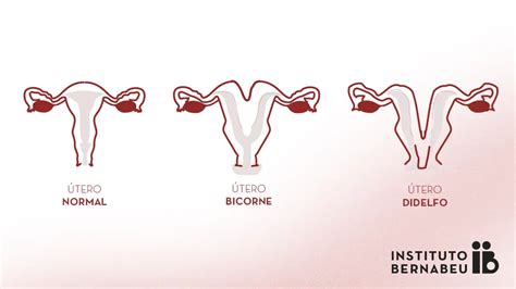 Esquema del útero bicorne y un útero normal