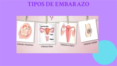 Diagrama comparativo de diferentes tipos de embarazo ectópico, incluyendo el cornual.