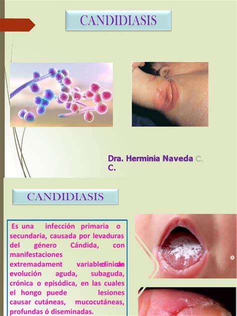 Infografía comparativa: diferencias entre síntomas de candidiasis mamaria y dermatitis de contacto.