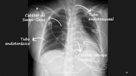 Radiografía de tórax que muestra la correcta colocación de un tubo endotraqueal.