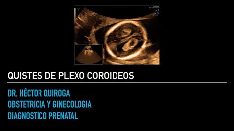 Ecografía de seguimiento mostrando la resolución de un quiste del plexo coroideo