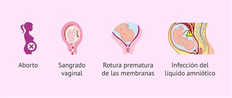 Ilustración del procedimiento de biopsia de vellosidades coriónicas