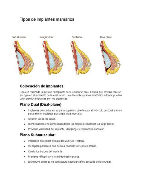 Diagrama mostrando la ubicación de implantes mamarios subglandular y submuscular