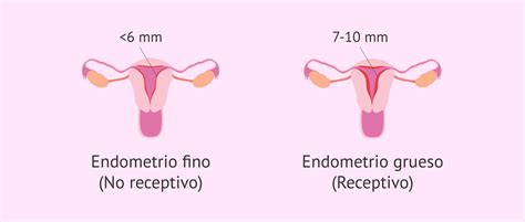 Representación de un blastocisto y un endometrio receptivo