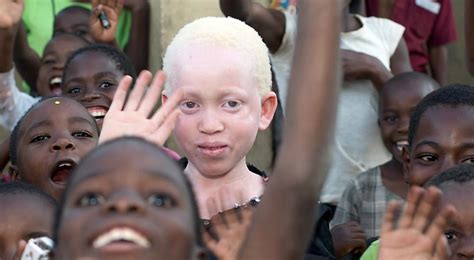 Retrato de un niño con albinismo en un entorno africano.