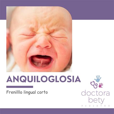 Infografía detallando los síntomas de anquiloglosia en bebés y madres durante la lactancia materna.