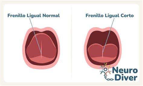 Diagrama que muestra la anatomía del frenillo lingual y su impacto en la movilidad de la lengua.