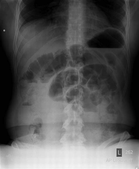 Radiografía de abdomen de un neonato mostrando asas intestinales dilatadas