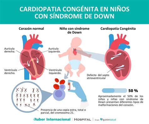 Gráfico con estadísticas sobre cardiopatías congénitas en España.