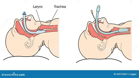 Ilustración de un tubo endotraqueal insertado en la tráquea de un recién nacido.
