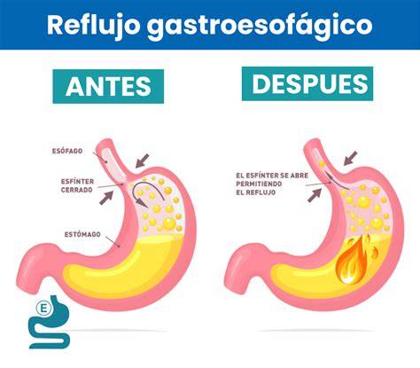Diagrama que ilustra el proceso de reflujo gastroesofágico en lactantes