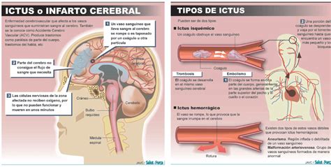 Infografía detallando los tipos de ictus (isquémico y hemorrágico)